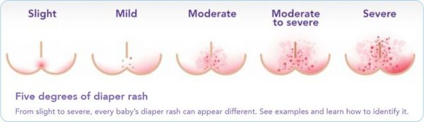 Diaper Rash – All you need to know about