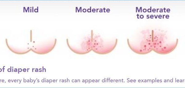 Diaper Rash – All you need to know about
